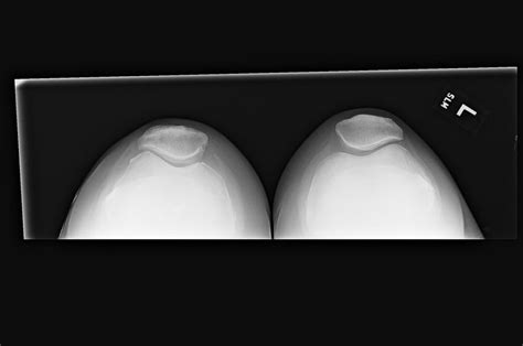 odd facet|patellofemoral xrays.